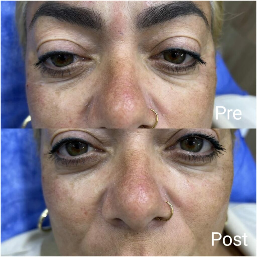 Improving the appearance of under the eyes for women before and after